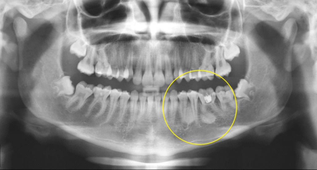 Radiopacidades observadas na região perirradicular entre os elementos 34 e 35, assim como na região periapical do 36. Neste último, material radiopaco pode ser observado na sua câmara pulpar, indicando manipulação endodôntica; a radiopacidade na região periapical do 36 sugere OEF ou osteíte condensante; a critério clínico sugerimos acompanhamento.