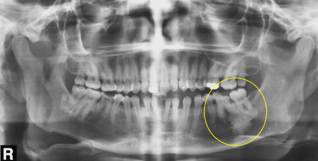 Imagem radiopaca observada em periápice dos dentes 36 e 37 (notar destruição da porção coronária da unidade 36 e da reabsorção radicular externa de sua raiz distal). Apesar de a radiopacidade mostrar-se extensa, os espaços pericementários, tanto da raiz distal do dente 36 quanto das raízes do dente 37, podem ser observados, o que sugere OES. No entanto, um acompanhamento clínico-radiográfico se faz necessário.
