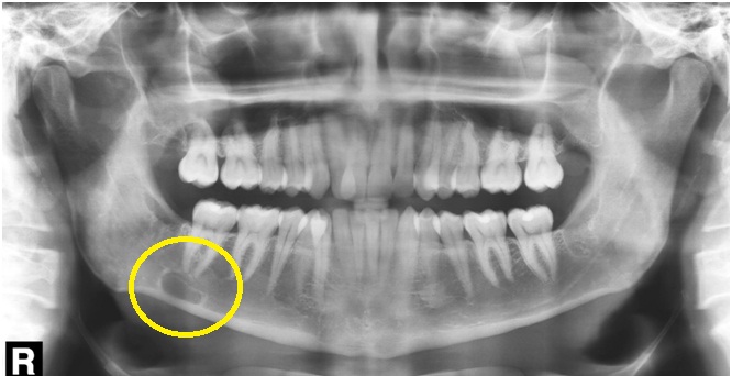 Cao I - Imagem radiolúcida de limites definidos e corticalizados, em corpo da mandíbula, do lado direito, projetada entre o canal da mandíbula e a base da mandíbula (próxima ao ápice do 47) – Defeito ósseo de desenvolvimento da mandíbula (DODM).