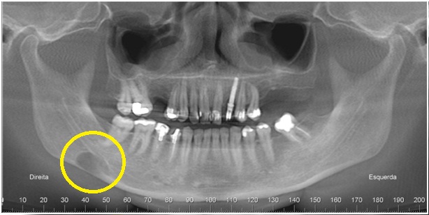 Caso II: Vista panorâmica, mostrando imagem hipodensa, de limites definidos e corticalizados, em corpo da mandíbula, do lado direito, entre a cortical do assoalho do canal da mandíbula e a base da mandíbula.