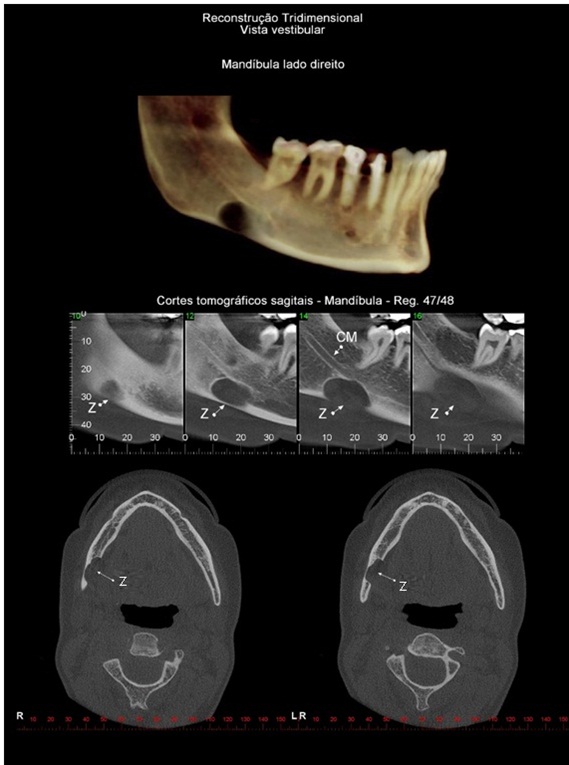 Caso II: Vista panorâmica, reconstrução 3D, sequencia de cortes sagitais e axiais; observa-se hipodensidade no corpo da mandíbula, lado direito. Observar a concavidade na face lingual do corpo da mandíbula (Z), envolvimento do tecido medular, discreto abaulameto da cortical vestibular. Notar a relação com o trajeto do canal da mandíbula (C.M.). Defeito ósseo de desenvolvimento da mandíbula, Subtipo III.