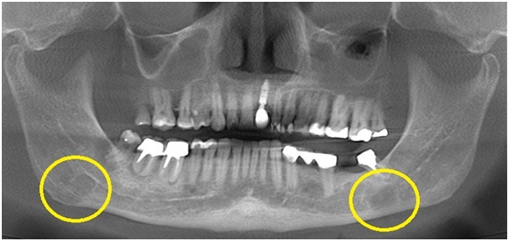 Caso IV: Vista panorâmica, mostrando imagem hipodensa em porção posterior do corpo da mandíbula, bilateral.