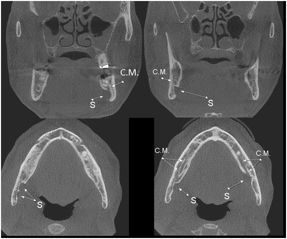 Caso IV: Cortes tomográficos coronais e axiais; concavidade no corpo da mandíbula (S) e em proximidade com o canal da mandíbula (CM). Defeito ósseo de desenvolvimento da mandíbula. Subtipo II.