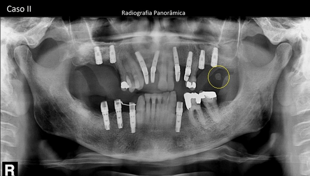 Observa-se nódulo radiopaco e, ao centro, radiolucência. A referida imagem projeta-se em partes moles, e por esta incidência panorâmica, localiza-se inferiormente ao processo alveolar da maxila ao lado esquerdo.