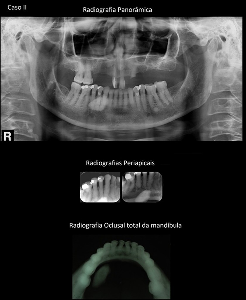 Legenda para o caso II - Por meio da radiografia panorâmica, nota-se imagem radiopaca, de aspecto oval projetada ao processo alveolar da mandíbula, ao lado direito. Pela incidência radiográfica periapical, verificamos a imagem radiopaca projetada ao periápice dos dentes 44 e 45. A radiografia oclusal total da mandíbula, complementar, mostra que a imagem radiopaca está situada em partes moles (espaço sublingual) : imagem compatível com sialólito da glândubla sublingual.