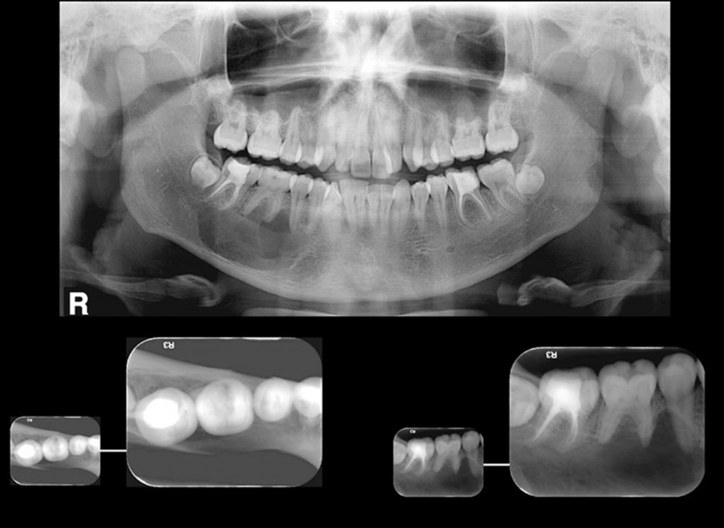 Paciente do gênero feminino, 16 anos de idade. A radiografia panorâmica mostra imagem radiolúcida de limites discretamente definidos e corticalizados, interdigitando-se entre as raízes dos pré-molares e molares, na mandíbula, lado direito. No detalhe: pela vista oclusal (técnica de Miller-Winter), a cortical lingual mostra-se adelgaçada, porém não há aumento de volume. A radiografia periapical mostra a interdigitação da lesão por entre os dentes 47, 46 e 45. Imagem compatível com COT.