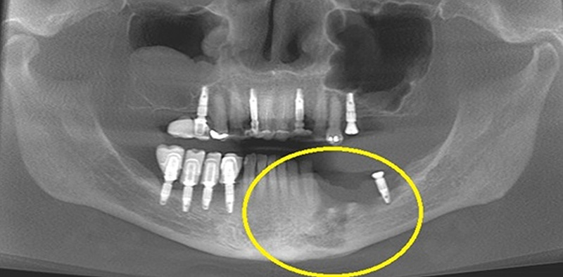 Paciente do gênero feminino, 64 anos. Solicitação de tomografia para região de processo alveolar e corpo da mandíbula lado esquerdo, onde houve a retirada de implantes instalados às regiões correspondentes aos pré-molares e molares. Segundo informações colhidas com o profissional solicitante, e anamnese, o paciente apresentava coleção purulenta (periimplantite) e dor na região, após 3 meses da retirada dos implantes.