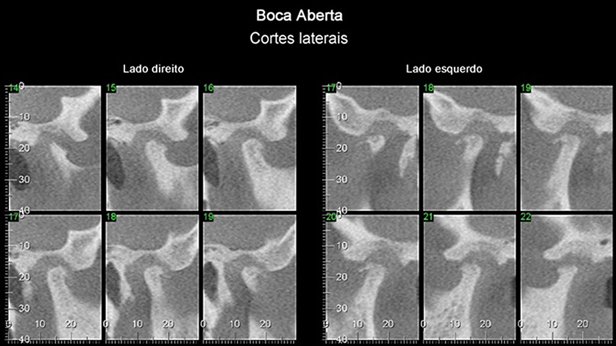 Paciente do gênero feminino, 57 anos. Cortes laterais da ATM, em boca aberta. Notamos que as cabeças da mandíbula estão posicionadas aquém do LAA; hipoexcursão/hipomobilidade bilateral. Há osteofito na vertente anterior da cabeça da mandíbula do lado esquerdo