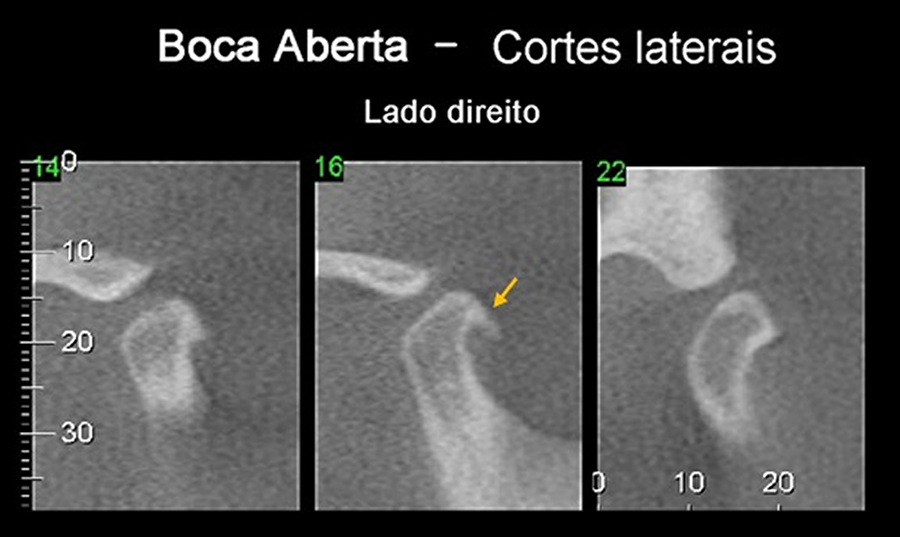 Paciente do gênero feminino, 54 anos.Formação osteofítica/osteófito na vertente anterior da cabeça da mandíbula, lado direito. Note a hipermobilidade neste lado (o polo superior da cabeça da mandíbula está além do limite articular anterior).