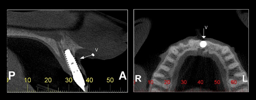 Paciente do gênero feminino, 32 anos. Estudo para a região periimplantar vestibular, do implante instalado na região correspondente ao dente 21. Parte da cortical vestibular não é observada – correspondente ao terço médio do implante – sugerindo fenestração.