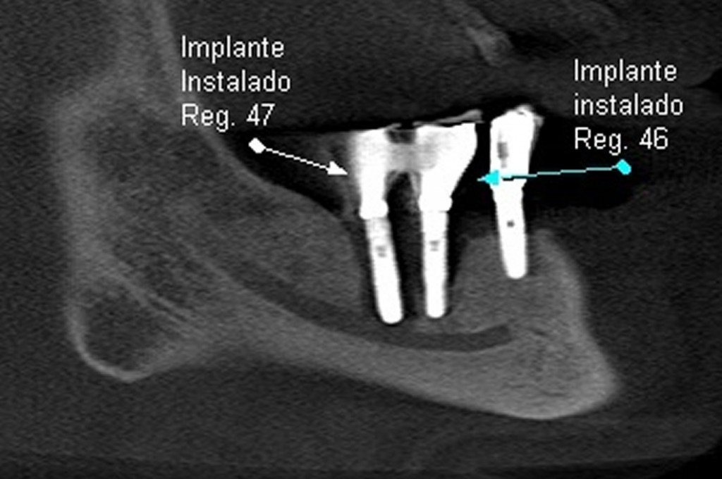 Paciente do gênero masculino, 61 anos. Cortes tomográficos de implantes instalados nas regiões correspondentes aos dentes 47 e 46; verificamos imagem hipodensa periimplantar, compatível com rarefação óssea (periimplantite); parte do teto do canal da mandíbula não pode ser observado.