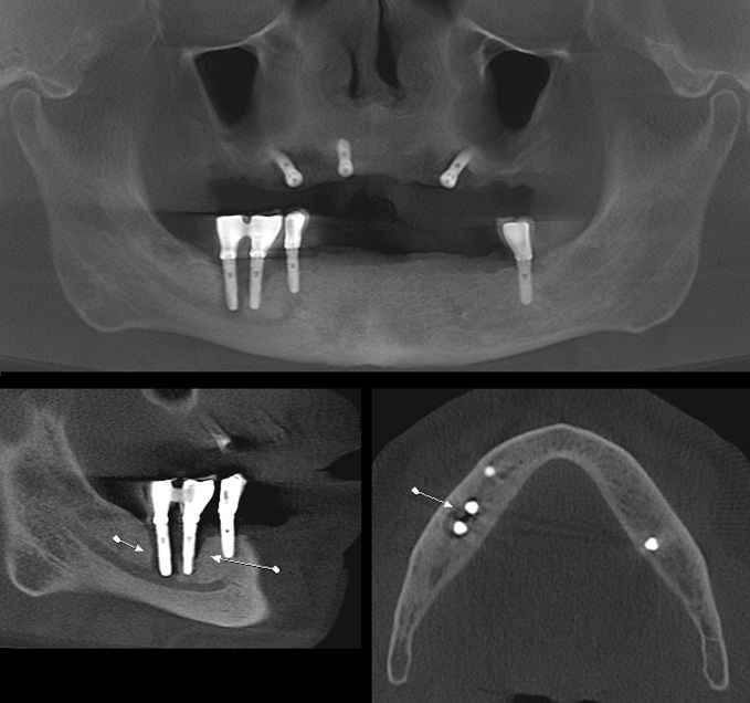 Vista panorâmica e cortes sagital e axial da mandíbula. Os implantes instalados nas regiões correspondentes aos dentes 47 e 46 mostram imagem hipodensa (setas) compatível com rarefação óssea periimplantar que estende-se até o canal da mandíbula, com solução de continuidade do teto deste.