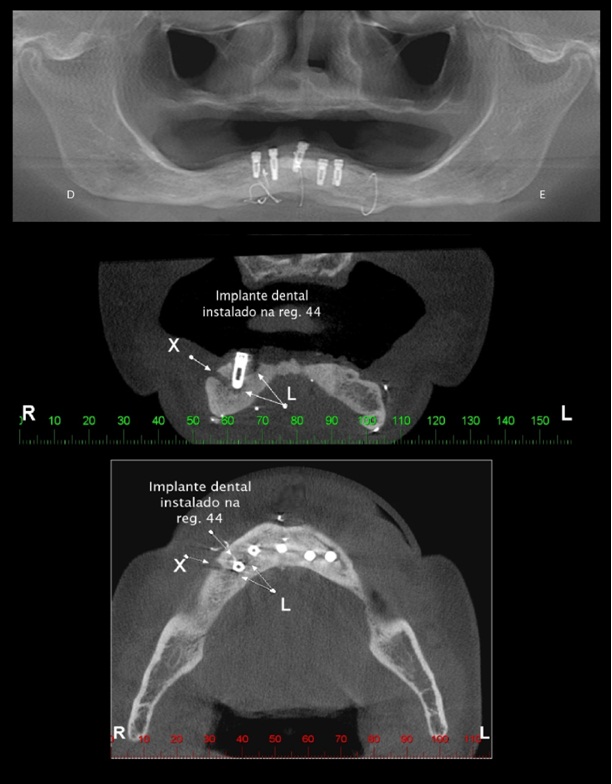 Vista panorâmica, cortes coronal e axial mostrando implante dental instalado na região correspondente ao dente 44; observa-se imagem compatível com rarefação óssea periimplantar (L) que mantém contato com a emergência do forame mentual.