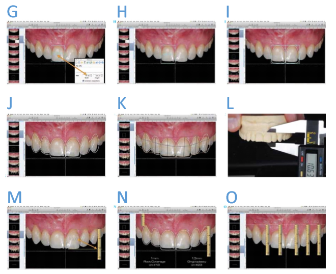 Foto intraoral em relação à cruz facial e com a análise de proporção dental (G). Colocação de um retângulo com proporção ideal (80{2c06b44a5821e3e88dccec8949716f012ab2ba8738cc7f90a1c8185fad37a756}) (H). Desenho dental efetuado, guiado pela cruz facial e pelo retângulo de proporção ideal (I). Desenho dental mostrando a relação pré-operatória com o design ideal (J). Outros desenhos podem ser efetuados para melhorar o entendimento estético e a comunicação (K). Medindo o comprimento do incisivo central no modelo. Essa medida será transferida para o computador para a calibragem da régua digital (L). Calibragem da régua digital (M). Utilização da régua digital para medir as discrepâncias entre o estado atual e o ideal (N). Transferência da cruz do computador para o modelo utilizando a régua digital e um paquímetro (O-Q). Confecção do enceramento de diagnóstico guiado pela cruz, desenhada no modelo, e pelas demais medidas provenientes do DSD (R).