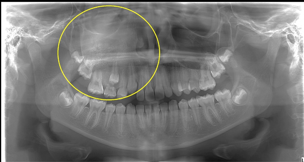 Caso I - Perda de definição da trabeculas ósseas em processo alveolar da maxila, conferindo imagem de densidade mista, predominamente radiopaca, lado direito; notar o aspecto de “vidro despolido/padrão marmóreo” que projeta-se em região do seio maxilar correspondente. Displasia Fibrosa.