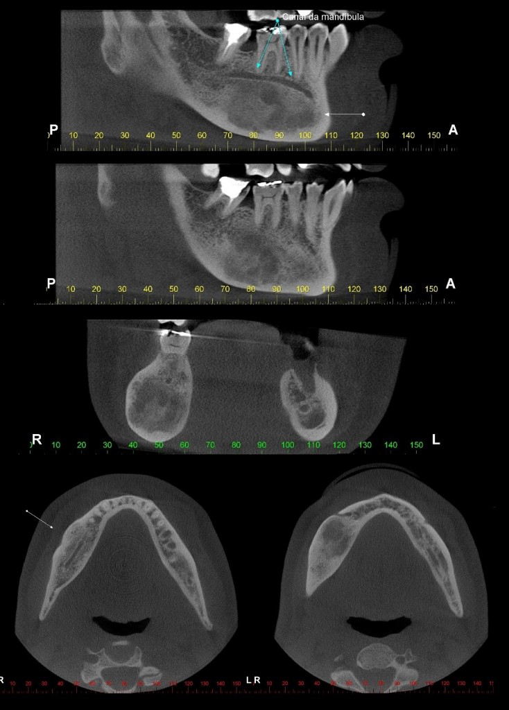 Caso III - Imagem de densidade mista em processo alveolar e corpo da mandíbula, lado direito. Notar aumento de volume das corticais vestibular, lingual e da base da mandíbula adjacentes; há, ainda, deslocamento da trajetória do canal da mandíbula em direção à crista óssea alveolar. Displasia Fibrosa.