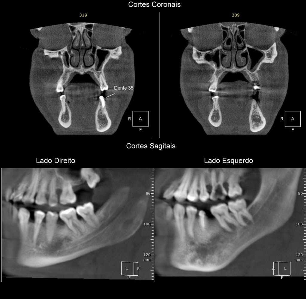 Caso IV – Imagem de densidade mista, observada em corpo e base da mandíbula (com evidente expansão desta última), do lado esquerdo. É possível notar, por meio dos cortes coronais, a diferença do volume e da morfologia entre o processo alveolar e corpo da mandíbula do lado esquerdo e seu correspondente contralateral.