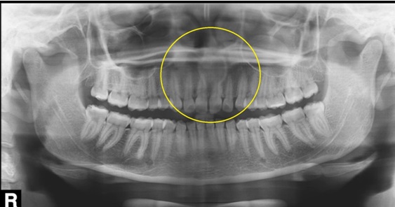 Imagem radiolúcida de limites definidos e corticalizados em região de linha média da maxila – superiormente aos ápices dos dentes incisivos centrais superiores – Cisto do Canal Nasopalatino
