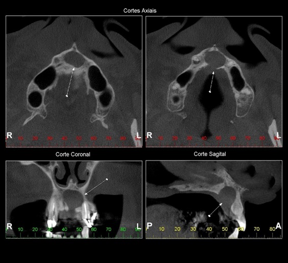 Imagem hipodensa, unilocular, de limites definidos e corticalizados, em região de linha média da maxila (setas), com rompimento da cortical palatal, mantendo contato com o assoalho da cavidade nasal – Cisto do Canal Nasopalatino.