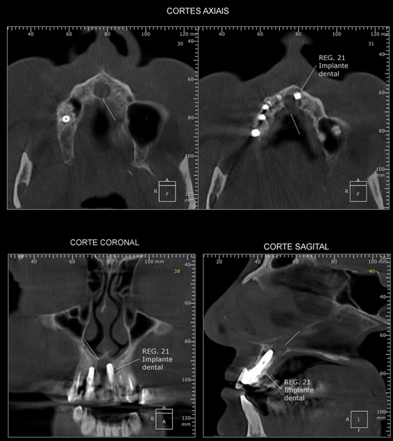 Imagem hipodensa, unilocular, de limites definidos e corticalizados, em região de linha média da maxila (setas), com rompimento das corticais palatal e do assoalho da cavidade nasal; notar comprometimento da região perimplantar correspondente ao implante instalado na região do dente 21 – Cisto do Canal Nasopalatino.