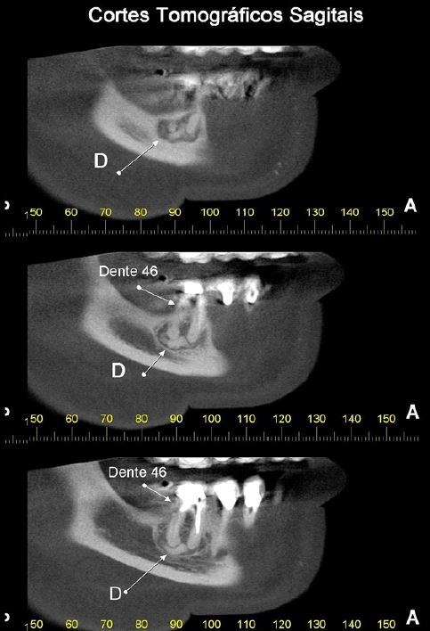 Sequência de cortes sagitais mostrando imagem de densidade mista envolvendo o periápice do dente 46. DCOP fase 2ª (cementoblástica)