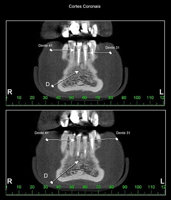Cortes tomográficos coronais dos dentes incisivos centrais inferiores (Dentes 41 e 31), apresentando imagem predominantemente hiperdensa envolta por halo radiolúcido em seus respectivos periápices – DCOP (item D) fase 3ª (Maturação)