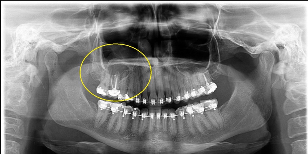 Imagem radiolúcida, circunscrita, de limites definidos e corticalizados, unilocular, envolta por halo radiopaco, possivelmente associada ao dente 16 (notar alargamento do forame apical de sua raiz palatal), mantendo contato com as raízes dos dentes 17 e 15. Observa-se abaulamento do assoalho do seio maxilar. Cisto Periapical.