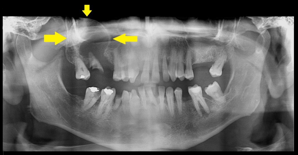 Cisto periapical associado às raízes (residuais) do elemento 17 e que se projeta para o interior do seio maxilar correspondente, com expressivo aumento de volume da cortical de seu assoalho. Este caso nos mostra a proporção exuberante que um cisto periapical pode alcançar – este cisto periapical ocupa grande parte do seio maxilar e estende-se em direção do assoalho da cavidade orbital.