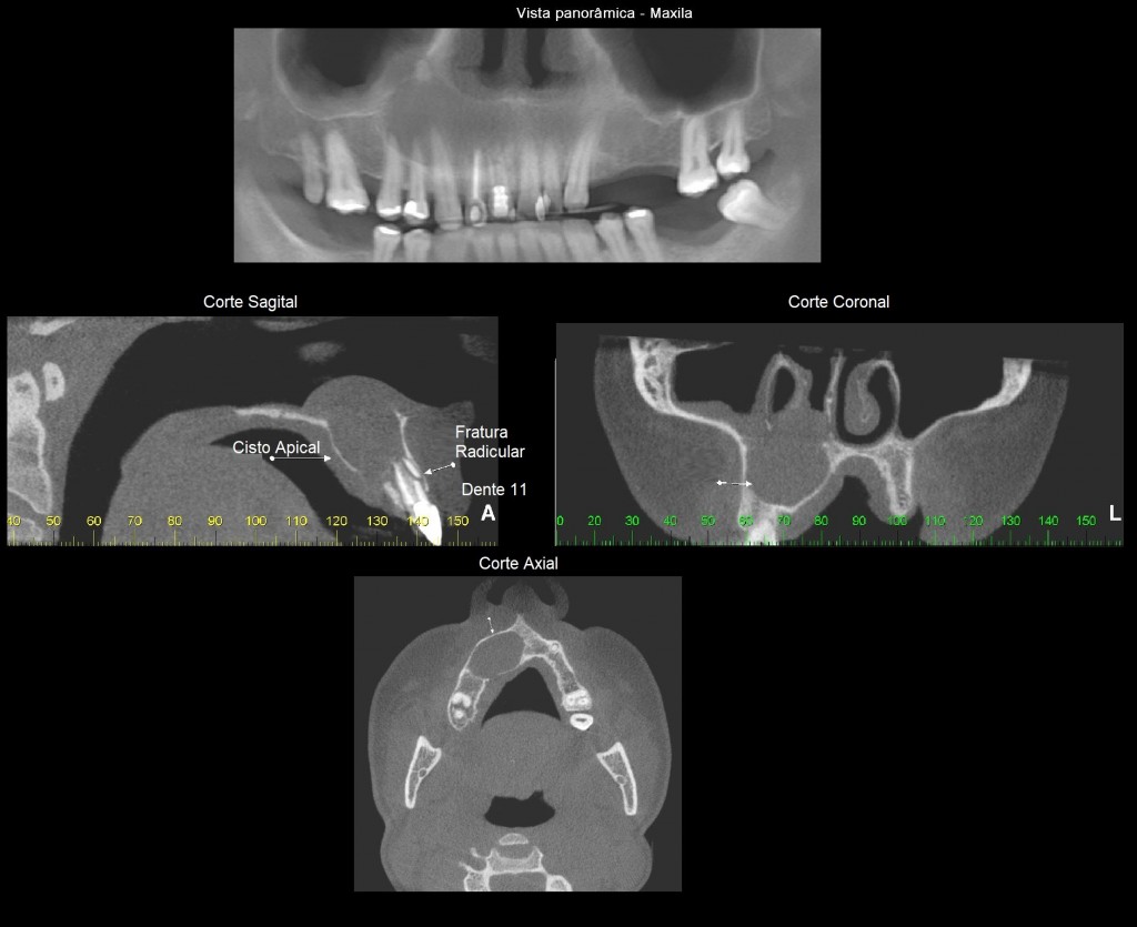 Cisto periapical, provavelmente associado ao elemento 11 (com fratura radicular), estendendo-se desde a raiz do dente 15 à região de linha média. Notar o extenso rompimento da cortical do assoalho da cavidade nasal (corte sagital) com extravasamento do conteúdo cístico para o seu interior (corte coronal).